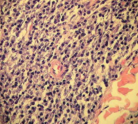 Primary Cutaneous Immunocytoma